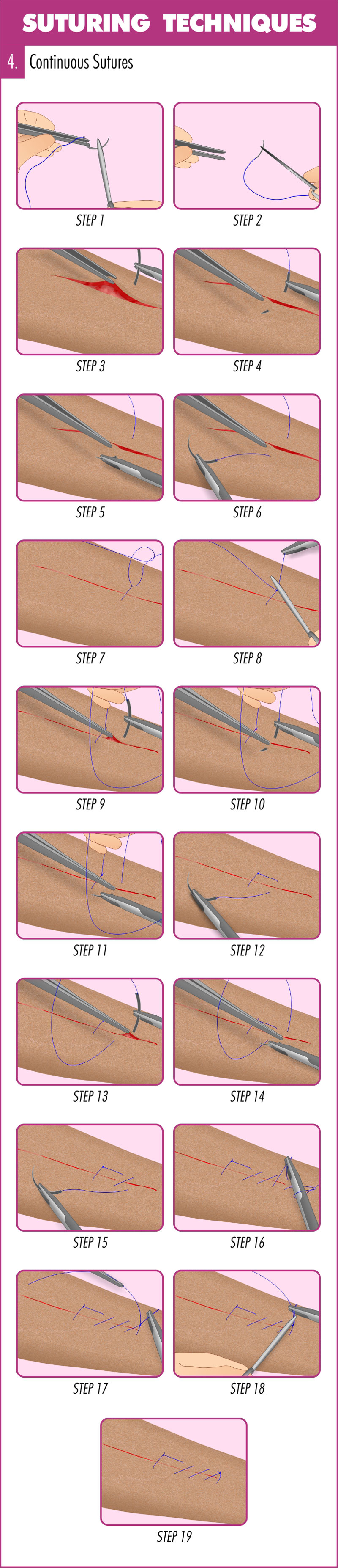 Frontiers | Single Purse-String Suture for Reinforcement of Duodenal Stump  During Laparoscopic Radical Gastrectomy for Gastric Cancer
