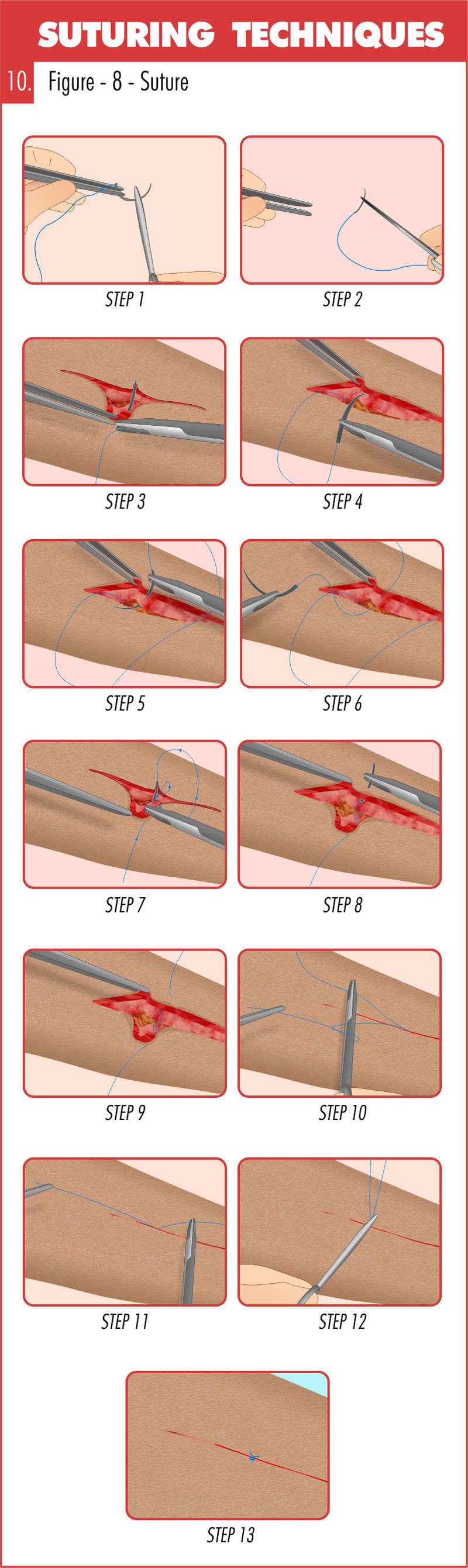 Anal Surgery for Hemorrhoids Technique: Rubber-Band Ligation, Coagulation,  Sclerotherapy
