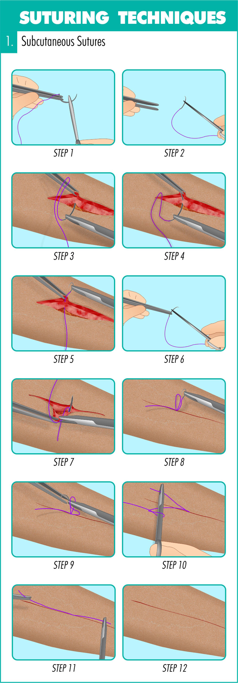Sutures: Types, Stitches, Techniques and Removal