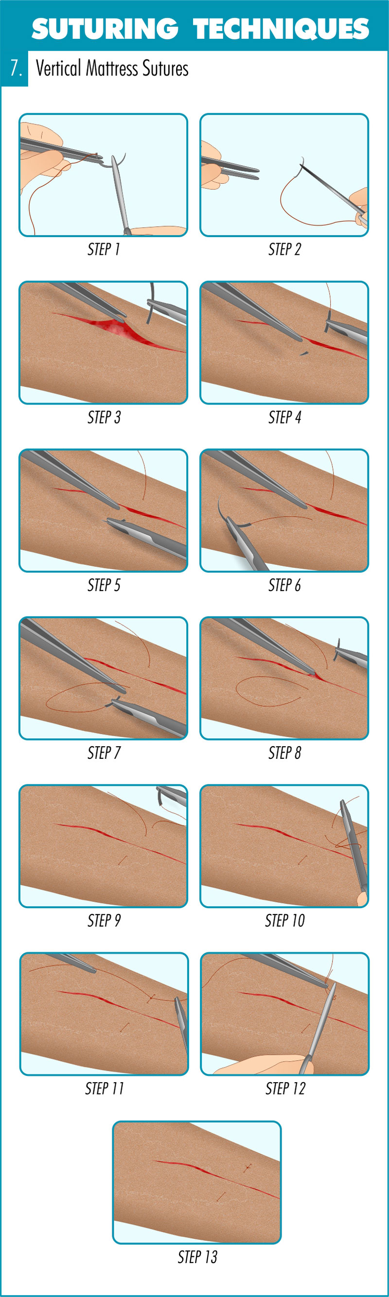 Purse-String Suture for Skin Closure Following Large Thyroidectomy